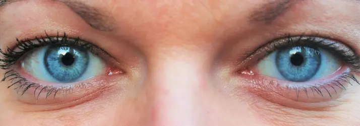 A close up pf a persons eyes. They are slightly red.